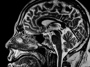 MRI image brain