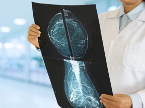 A gynecologist looks at a mammogram checking for breast cancer.