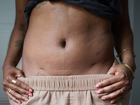 A woman shows the scars from a laparoscopy to excise lesions from her abdominal wall, appendix, bladder and colon due to endometriosis.