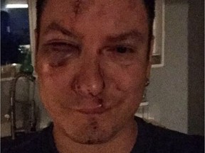 Eugene Grosh says he was beaten at a bar in Saskatoon on Saturday morning. Saskatoon police service are now investigating. The above photos were posted to Grosh's Facebook page as he provides his friends and the public updates on his recovery following the attack, an attack he says was rooted in the fact he is a gay man.