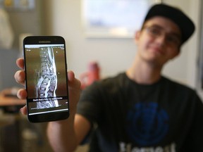 Nick Bailey, 17, holds up an x-ray image of his spine following an ATV accident near Colonsay