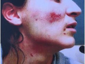 Court exhibit photo of the injuries 19-year-old Trent Blackbird sustained after he was assaulted by Cpl. Dean Flaman during an arrest in Warman on Feb. 24, 2016.