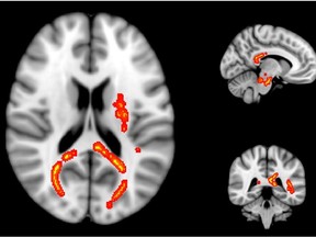 Areas of significantly reduced myelin  in athletes with concussion two weeks after an injury.