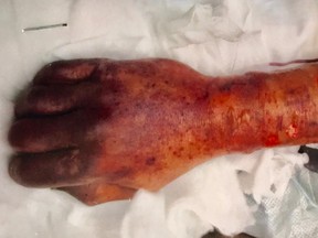The man's right forearm and hand shows gangrene appearing in the fingers.