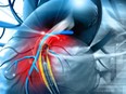 Smoking marijuana was associated with a higher risk of stroke after percutaneous coronary intervention. /