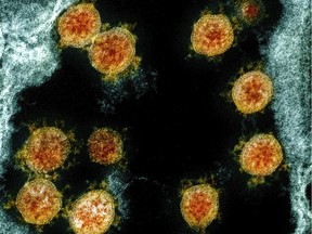 This electron microscope image  shows novel coronavirus SARS-CoV-2 virus particles, orange, isolated from a patient.