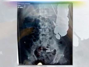 An endoscopy conducted on an Indian man revealed more than 15 pounds of metal in his stomach, including coins, nails and razor blades. (YouTube/News 24h)