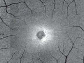 Adaptive optics image of Payne's retina. MUST CREDIT: JAMA Ophthalmology-New York Eye and Ear Infirmary of Mount Sinai

LARGER SIZE NOT AVAILABLE
JAMA Ophthalmology-New York Eye , JAMA Ophthalmology-New York Eye