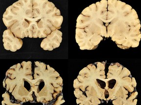 This combination of photos provided by Boston University shows sections from a normal brain, top, and from the brain of former University of Texas football player Greg Ploetz, bottom, in stage IV of chronic traumatic encephalopathy