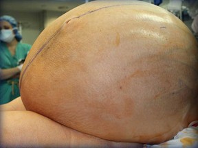 Doctors at Danbury Hospital in Connecticut operate on a woman with a 132-pound ovarian tumour.