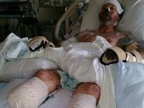 Greg Manteufel suffered sepsis after harmful bacteria from a dog’s saliva seeped into his bloodstream. His legs and hands have been amputated. (Photo via Dawn Manteufel)