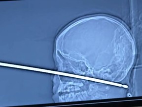 Xavier Cunningham is recovering after a meat skewer penetrated his skull. (YouTube/The University of Kansas Health System)