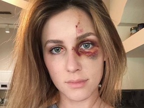 Melissa Gentz took to social media to show the beating her boyfriend allegedly gave to her.