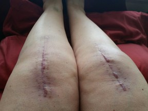 Rita DeMontis' legs six weeks post-surgery