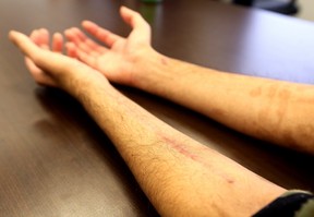 Gunshot victim Jamal shows some of his wounds. (Dave Abel, Toronto Sun)