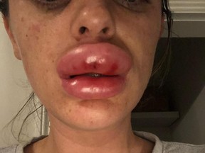 Rachael Knappier almost lost her upper lip thanks to a botched Botox injection.