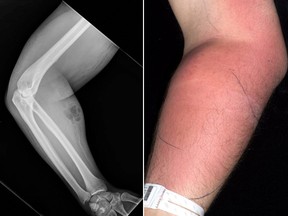 An X-ray revealed where an Irish man injected his own semen into his right forearm, which became infected. (Irish Medical Journal)