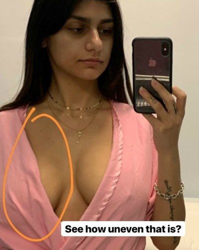 400px x 504px - Mia Khalifa has surgery for puck-ruptured breast implant | Toronto Sun