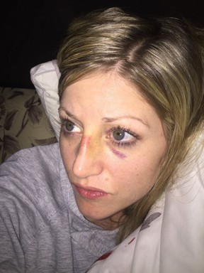 A photo of Jessica Donald with visible bruising on her face. SUPPLIED PHOTO