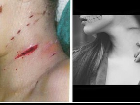 Then and now. .Jynnie Kent’s nect injuries. (Supplied photo)