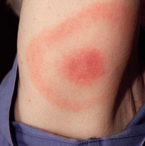 A bulls-eye rash commonly associated with Lyme disease