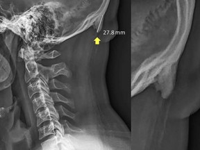 Researchers at the University of the Sunshine Coast in Queensland, Australia, have documented the prevalence of bone spurs at the back of the skull among young adults.