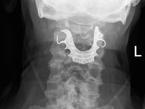 An X-ray shows dentures in a senior's throat. (British Medical Journal)