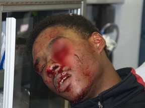A court exhibit showing injuries sustained by Dafonte Miller.The Toronto Sun pixelated the injury to his left eye.