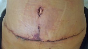 Abigail Fernandez’ botched tummy tuck. (HotSpot Media)