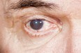 Eye disease infecting a brown eye. (Getty Images)