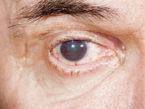 Eye disease infecting a brown eye. (Getty Images)