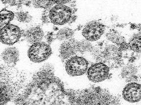 This 2020 electron microscope made available by the U.S. Centers for Disease Control and Prevention image shows the spherical coronavirus particles from the first U.S. case of COVID-19.