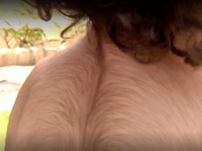Around 20 Spanish children sprouted hair all over their bodies after they were mistakenly given hair restorer for tummy troubles.