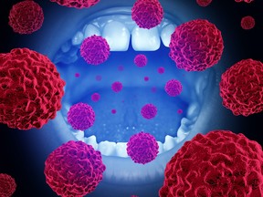 A mouth with malignant disease cells illustrating oral cancer.