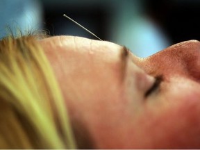 A woman is pictured during an acupuncture treatment