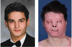 Joe DiMeo before and after surgery.