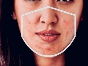 A woman with acne from mask-wearing.