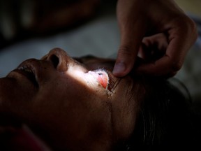 A doctor examines the eye of a man who is suffering from Mucormycosis, also known as black fungus, at a hospital in Ahmedabad, India, June 28, 2021.