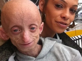 Ashanti Smith (left), seen here with her mother Phoebe Louise Smith, died July 17 while living with a genetic condition that rapidly aged her body.