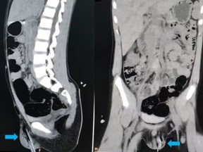 X-rays of boy whose scrotum was impaled with a stick after falling out of tree.