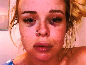 This unidentified woman's two black eyes allegedly came from Dodgers hurler Trevor Bauer.