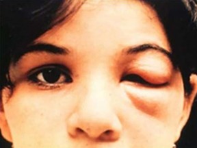 An 8-year-old girl in Brazil with Chagas disease from the kissing bug.