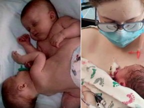 Charity Lincoln Gutierrez-Vazquez as a conjoined twin (left) and 21 years later, holding her newborn daughter, Alora