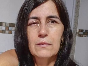 Woman's eye glued shut after boyfriend mistakes eyedrops for glue.