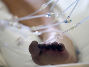 'Covid toes', a skin manifestation and symptom of COVID-19, are visible on a COVID-19 patient being treated in the Intensive Care Unit (ICU) at Sharp Grossmont Hospital on December 14, 2020 in La Mesa, California.