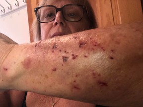 Donna Sanginario, of Massachusetts, shows off her wounds after being attacked by a raccoon in her yard on Dec. 1, 2021.