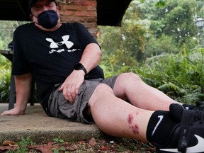 Singapore resident Graham George Spencer shows bite wounds on his right leg he received when he was attacked by otters in late November, at the Singapore Botanical Gardens, Saturday, Dec. 11, 2021.