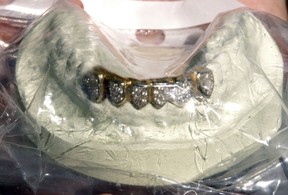 Twelve gold teeth encrusted with diamonds worth $1,000. FILE PHOTO
