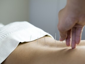 Traditional acupuncture treatment