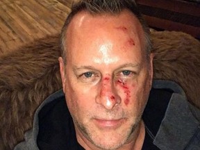 Dave Coulier - Mar 2022 - sober/bloody face - Insta - ONE USE